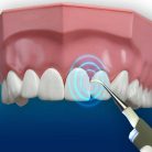 Elektromos fogtisztító – hangvibrációs / implantátum, korona, fogszabályzó és tömésbiztos